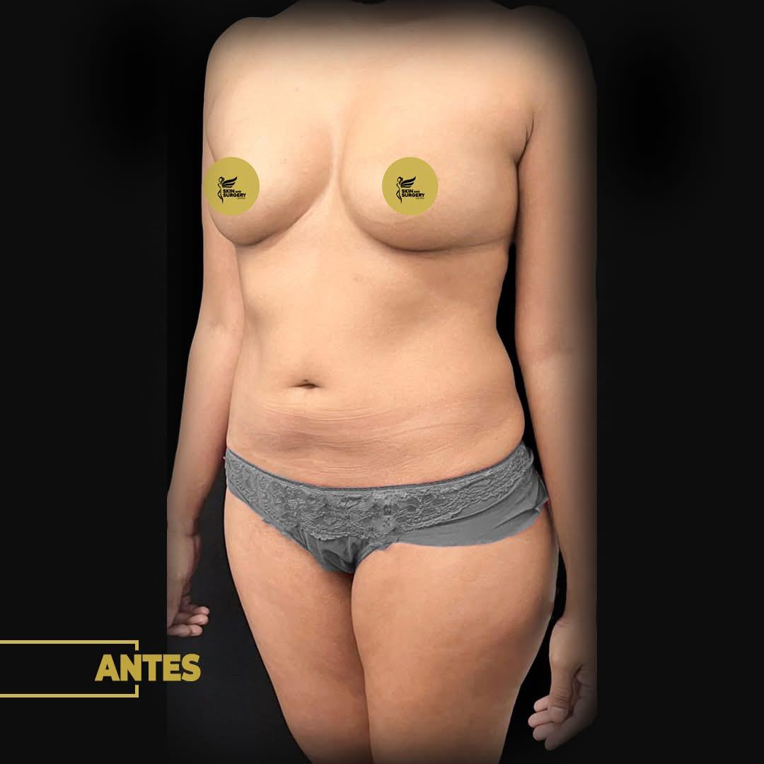 Vista frontal anterior de cirugía estética corporal