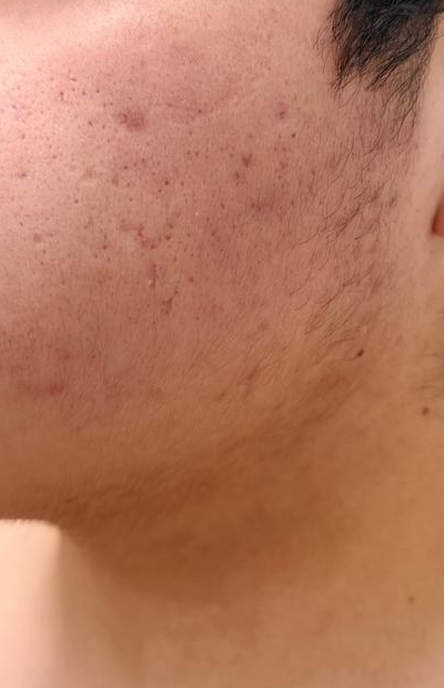 Primera mejilla, fotografía posterior del mismo caso