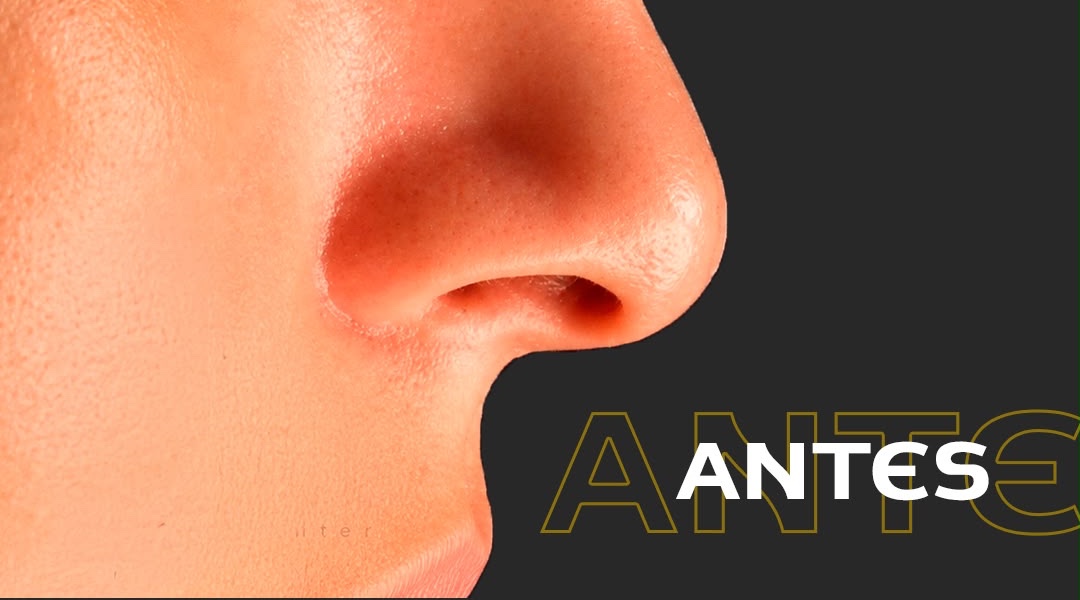 Perfil nasal antes de rinoplastia, con los ojos fuera del encuadre