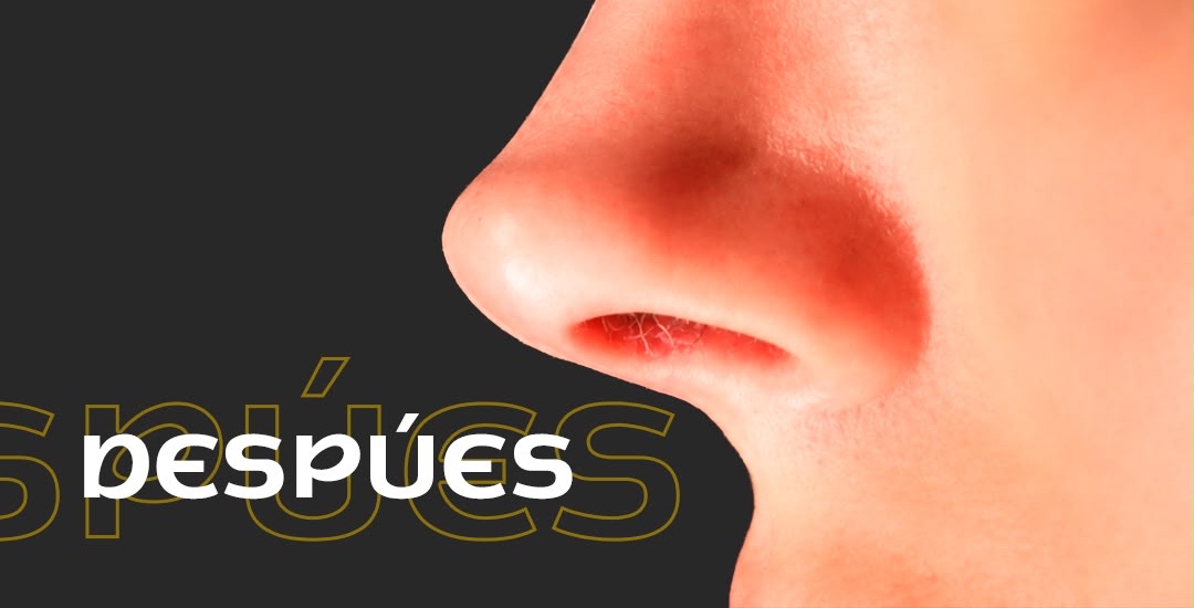 Perfil nasal después de rinoplastia, con los ojos fuera del encuadre